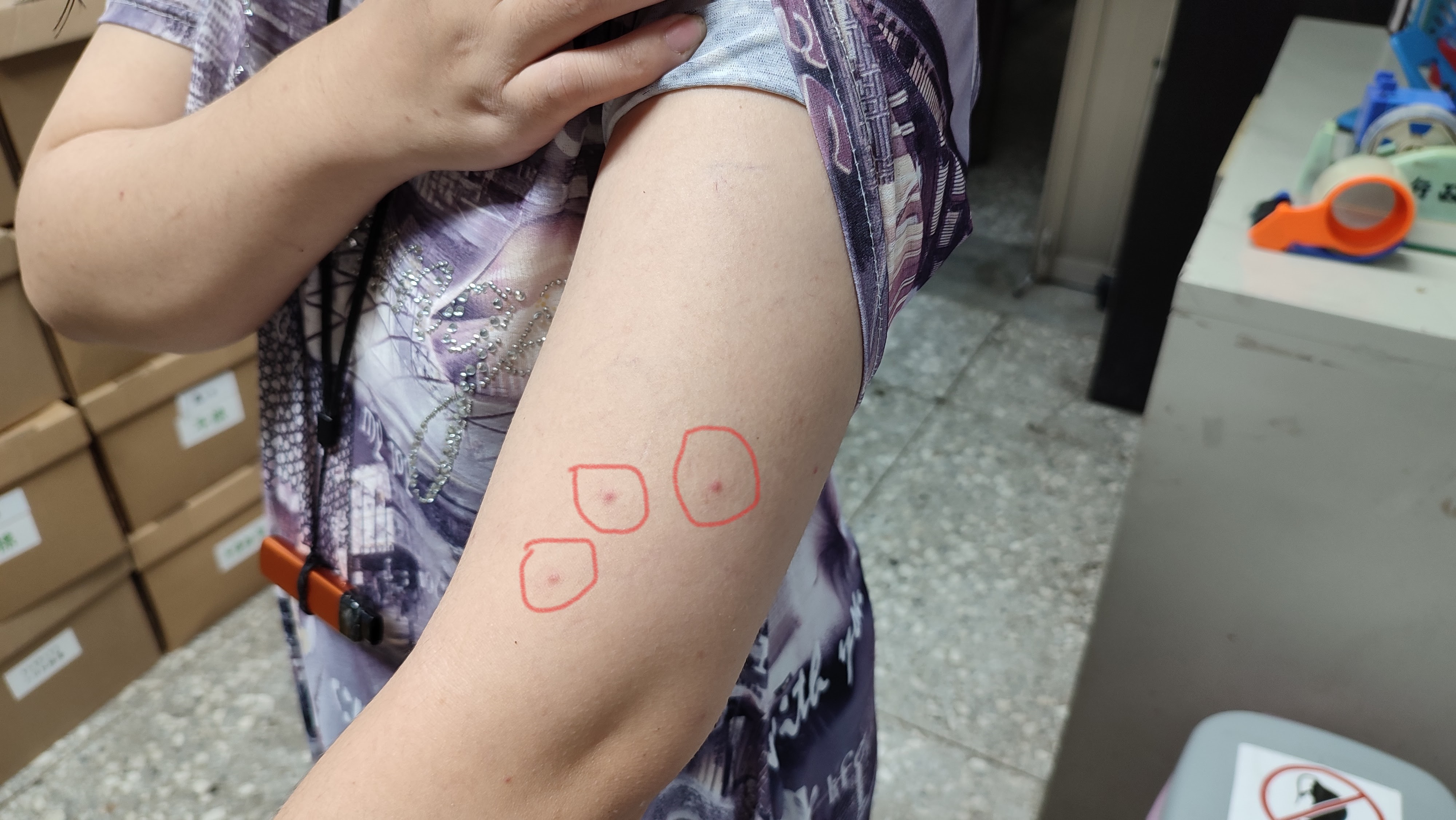 大多數蟎蟲生命期約3周內死亡。受害者呈三顆線狀或三角形排列的咬痕