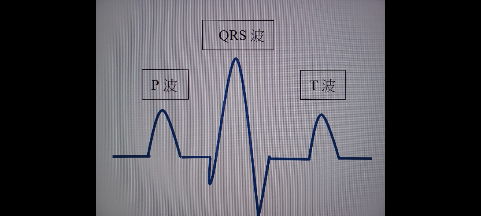 可藉由心電圖測量的P波、QRS波與T波來判讀心臟是否異常
